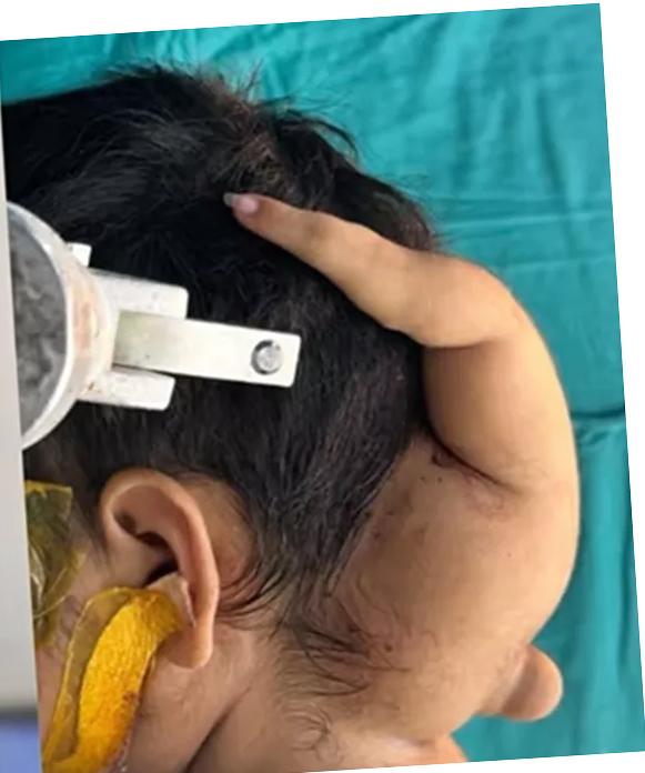 बच्ची के सिर और रीढ़ से चिपका था अजीब सा हाथ, एम्स भोपाल ने सर्जरी कर हटाया